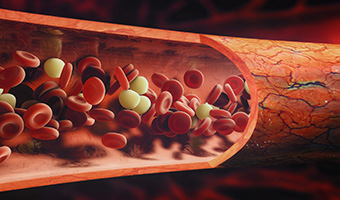 Acute & Chronic Inflammation - Causes, Symptoms & Treatment - Blood Count, Sedimentation